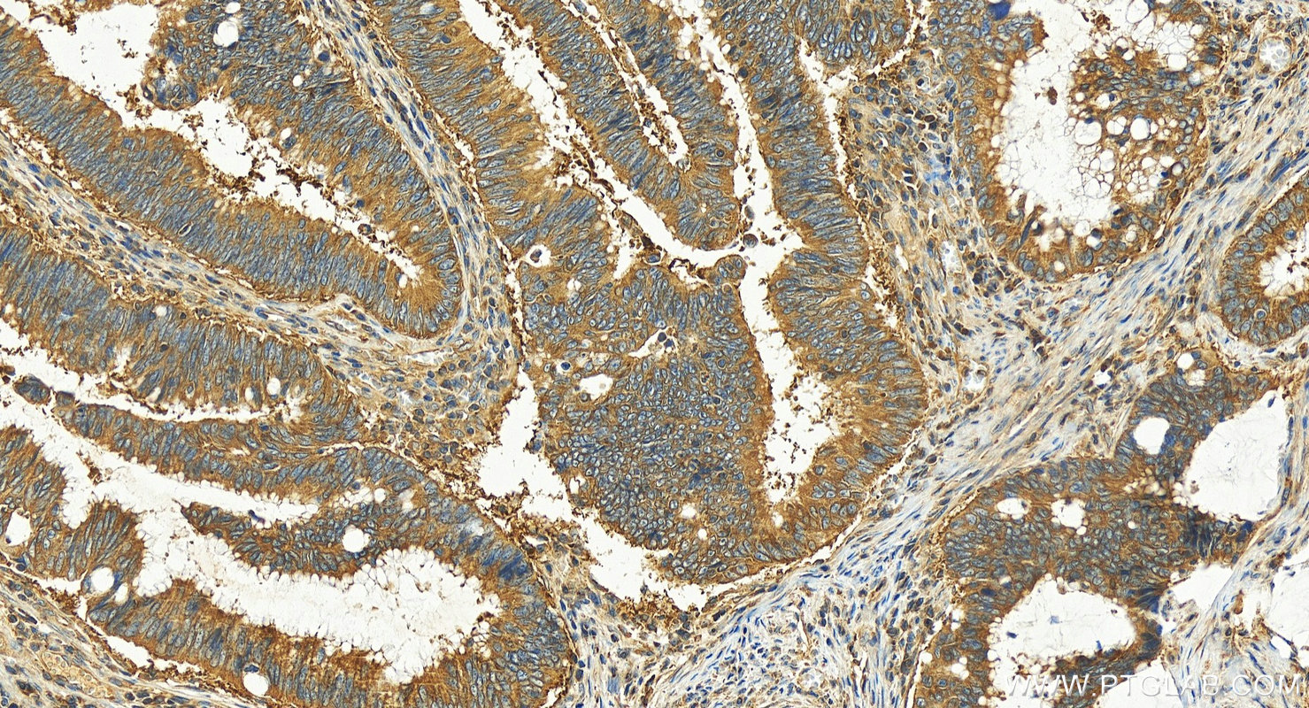 Immunohistochemistry (IHC) staining of human colon cancer tissue using ATG12 Polyclonal antibody (30505-1-AP)
