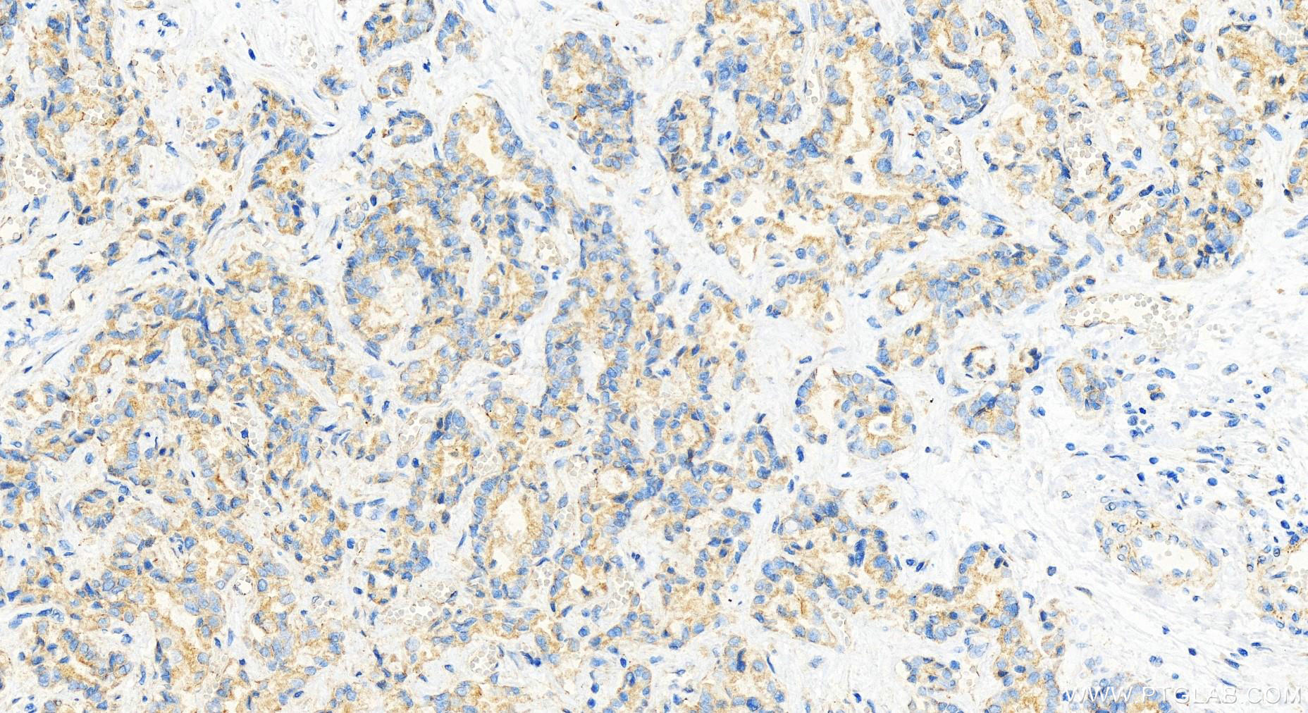 Immunohistochemistry (IHC) staining of human intrahepatic cholangiocarcinoma tissue using ATL2 Polyclonal antibody (16688-1-AP)