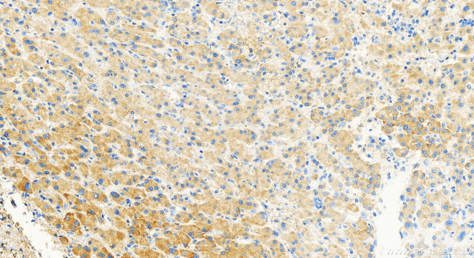 Immunohistochemistry (IHC) staining of human intrahepatic cholangiocarcinoma tissue using ATL2 Polyclonal antibody (16688-1-AP)