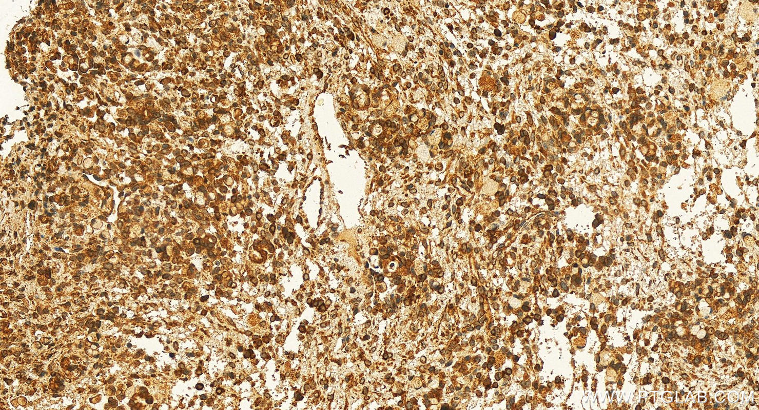 Immunohistochemistry (IHC) staining of human ovary cancer tissue using ATL2 Polyclonal antibody (16688-1-AP)