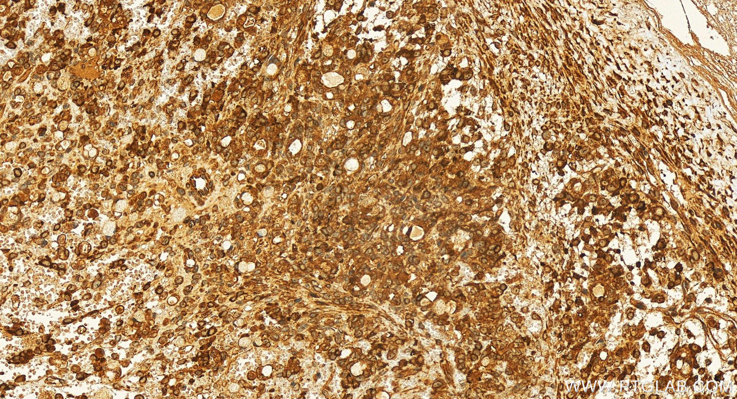 Immunohistochemistry (IHC) staining of human ovary cancer tissue using ATL2 Polyclonal antibody (16688-1-AP)