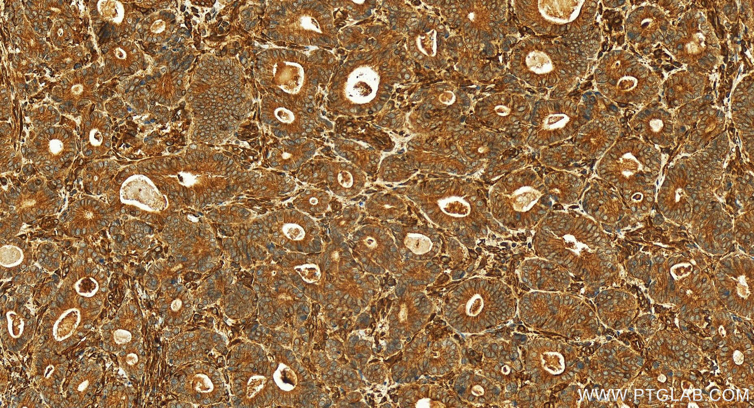 Immunohistochemistry (IHC) staining of human stomach cancer tissue using ATL3 Polyclonal antibody (16921-1-AP)