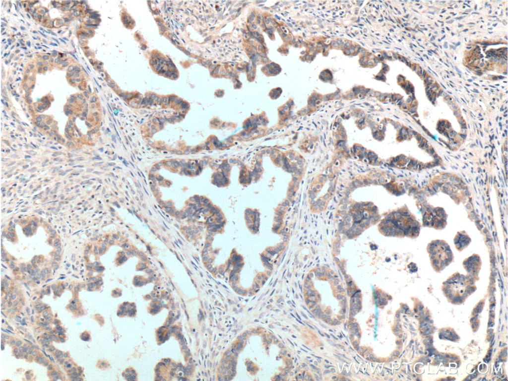 Immunohistochemistry (IHC) staining of human ovary tumor tissue using ATP11B Polyclonal antibody (13672-1-AP)