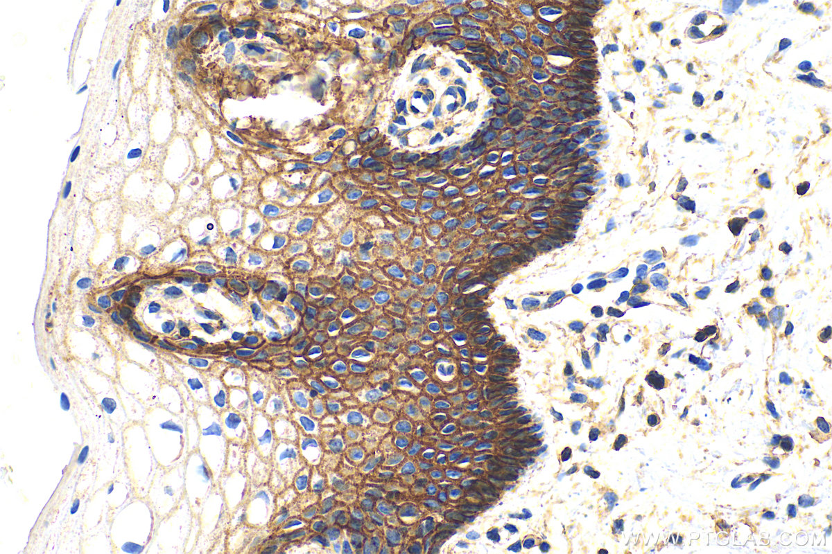 Immunohistochemistry (IHC) staining of human cervical cancer tissue using ATP1A1 Polyclonal antibody (14418-1-AP)