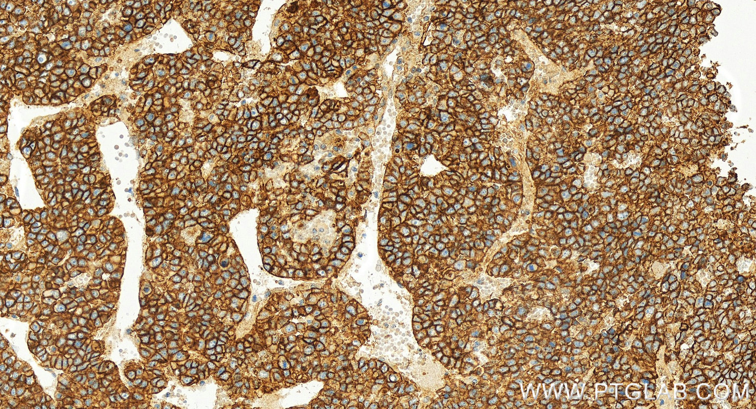 Immunohistochemistry (IHC) staining of human hepatocellular ca using ATP1A1-Specific Polyclonal antibody (55187-1-AP)