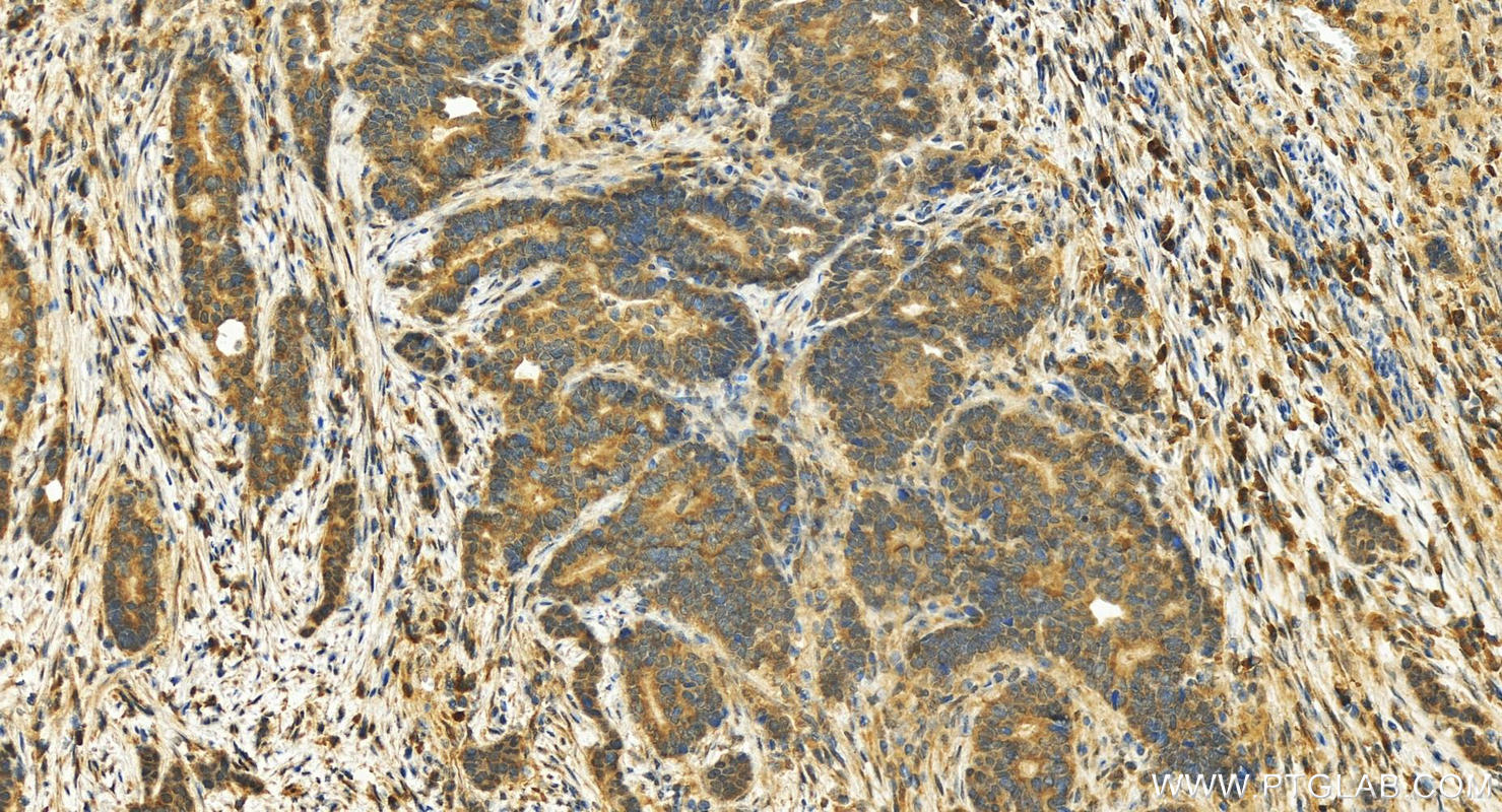 Immunohistochemistry (IHC) staining of human stomach cancer tissue using ATP4B Polyclonal antibody (18692-1-AP)