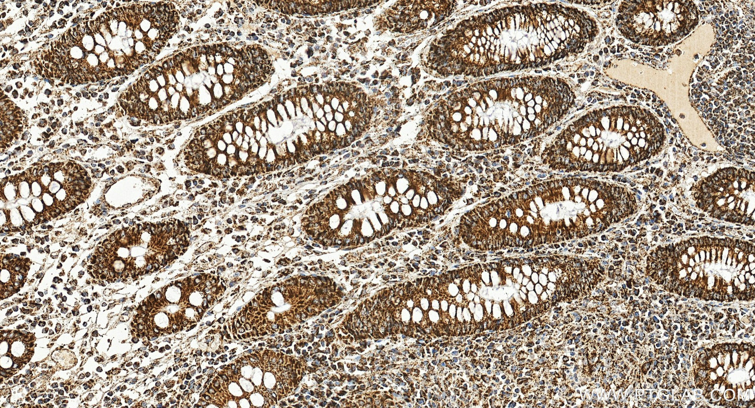 Immunohistochemistry (IHC) staining of human colon cancer tissue using ATP5A1 Monoclonal antibody (66037-1-Ig)