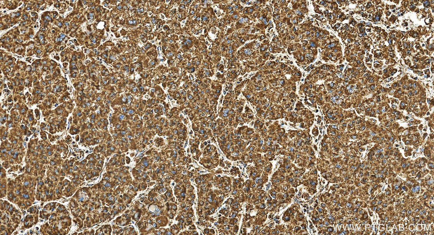 Immunohistochemistry (IHC) staining of Hepatocellular carcinoma tissue using ATP5A1 Monoclonal antibody (66037-1-Ig)