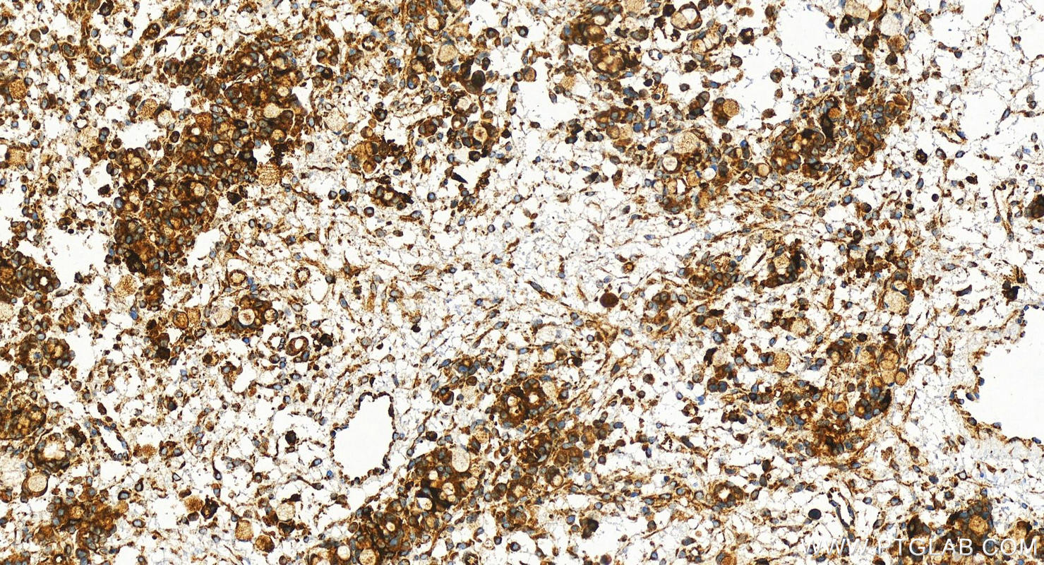 Immunohistochemistry (IHC) staining of human ovary cancer tissue using ATP6V1E1 Recombinant antibody (83636-6-RR)