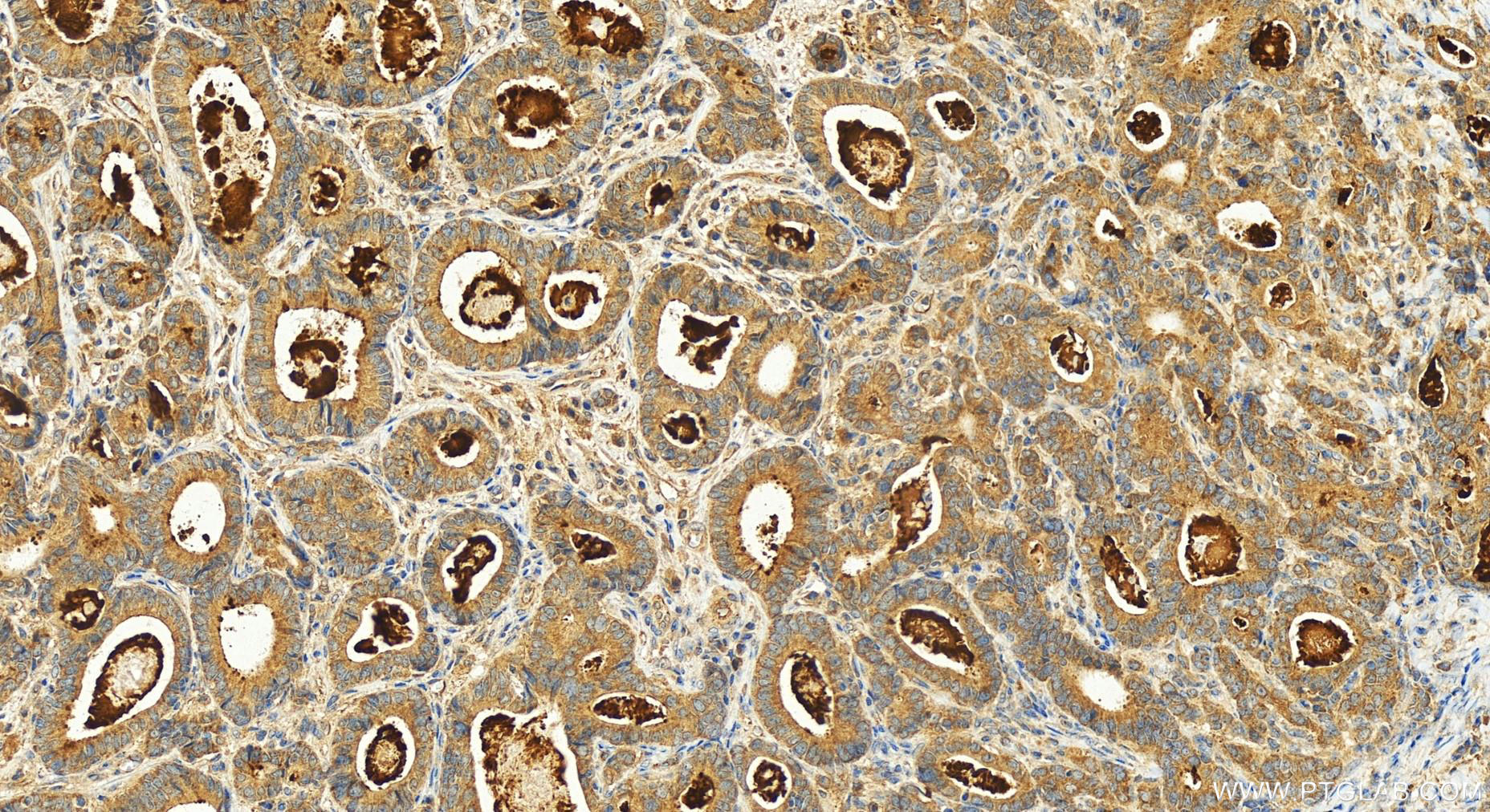 Immunohistochemistry (IHC) staining of human stomach cancer tissue using ATPAF1 Polyclonal antibody (15797-1-AP)