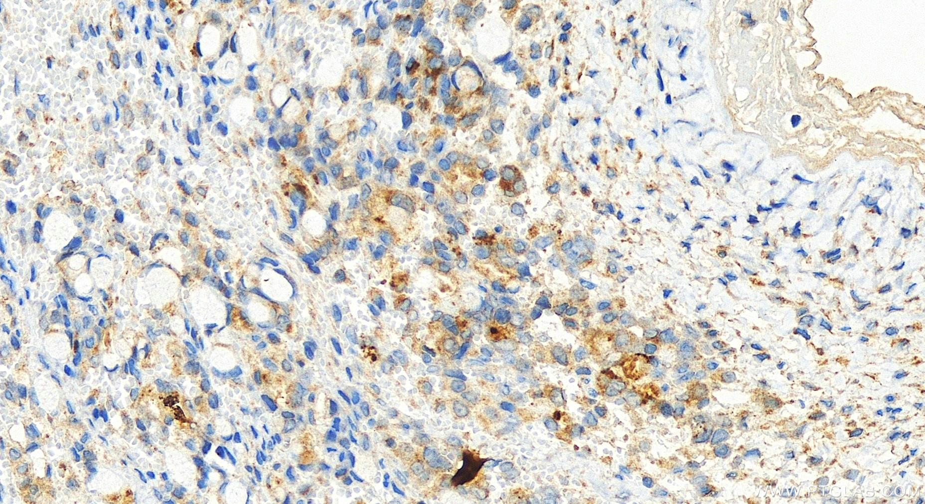 Immunohistochemistry (IHC) staining of human ovary cancer tissue using ATPAF1 Polyclonal antibody (15797-1-AP)