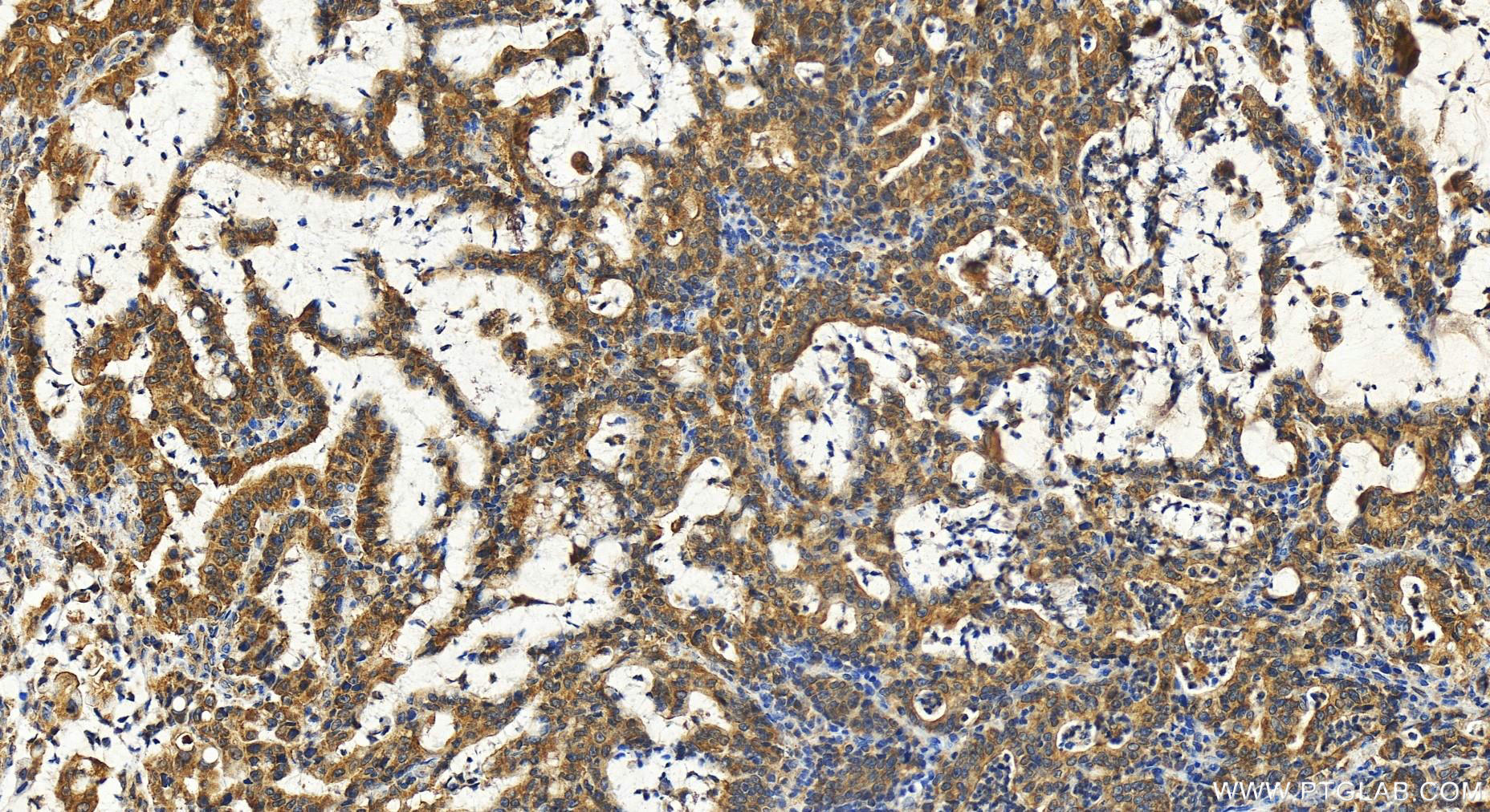 Immunohistochemistry (IHC) staining of human stomach cancer tissue using ATPAF2 Polyclonal antibody (30334-1-AP)