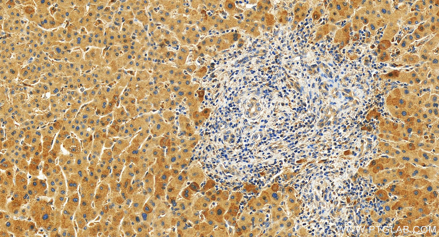 Immunohistochemistry (IHC) staining of human intrahepatic cholangiocarcinoma tissue using Adiponectin receptor 1 Polyclonal antibody (22425-1-AP)