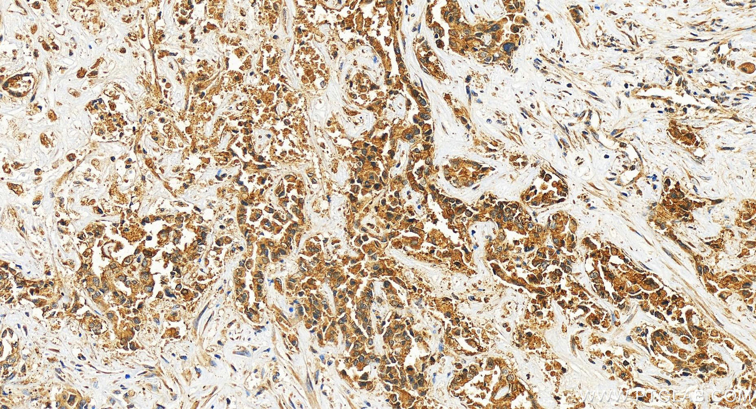 Immunohistochemistry (IHC) staining of human intrahepatic cholangiocarcinoma tissue using Adiponectin receptor 1 Polyclonal antibody (22425-1-AP)