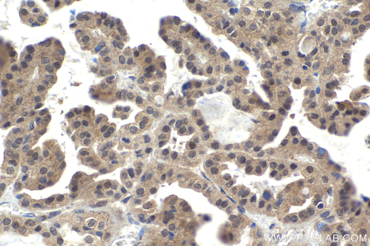 Immunohistochemistry (IHC) staining of human thyroid cancer tissue using Ajuba Polyclonal antibody (28686-1-AP)