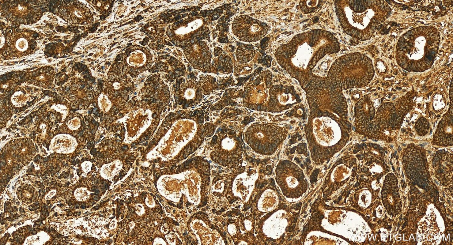 Immunohistochemistry (IHC) staining of human stomach cancer tissue using Alpha 1 microglobulin Polyclonal antibody (26716-1-AP)