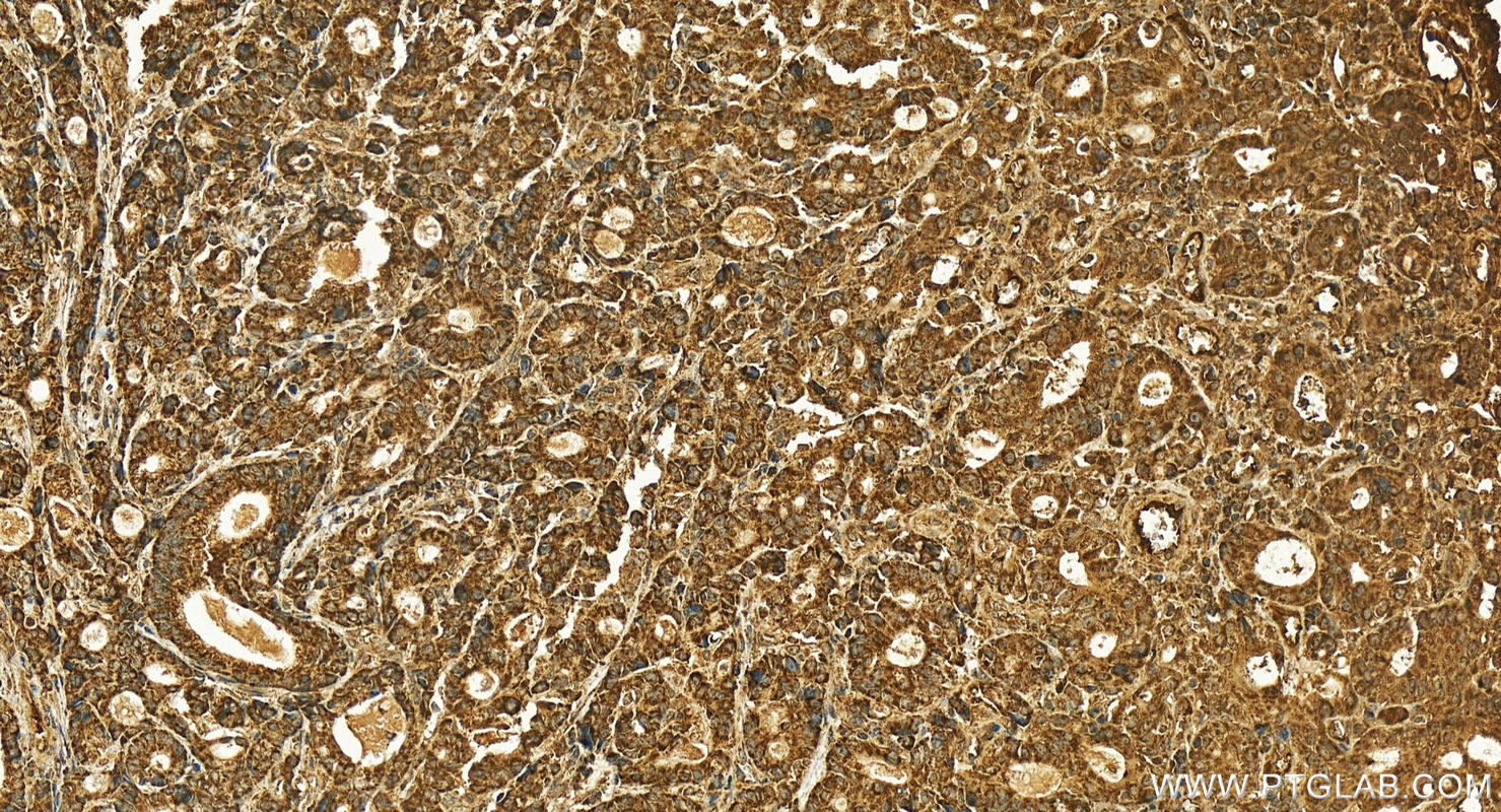 Immunohistochemistry (IHC) staining of human stomach cancer tissue using Alpha 1 microglobulin Polyclonal antibody (26716-1-AP)