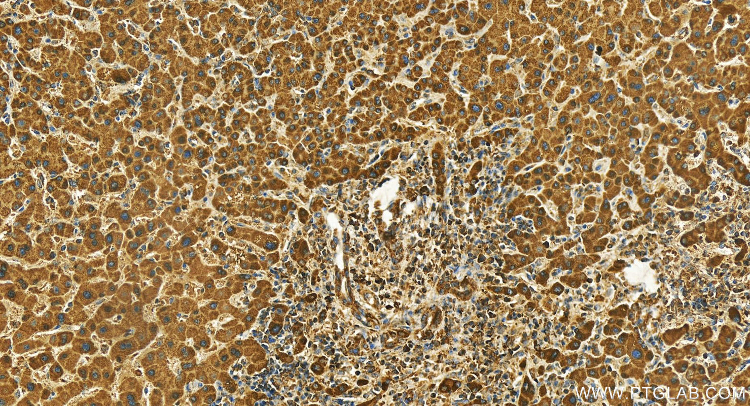 Immunohistochemistry (IHC) staining of human intrahepatic cholangiocarcinoma tissue using Alpha 1 microglobulin Polyclonal antibody (26716-1-AP)