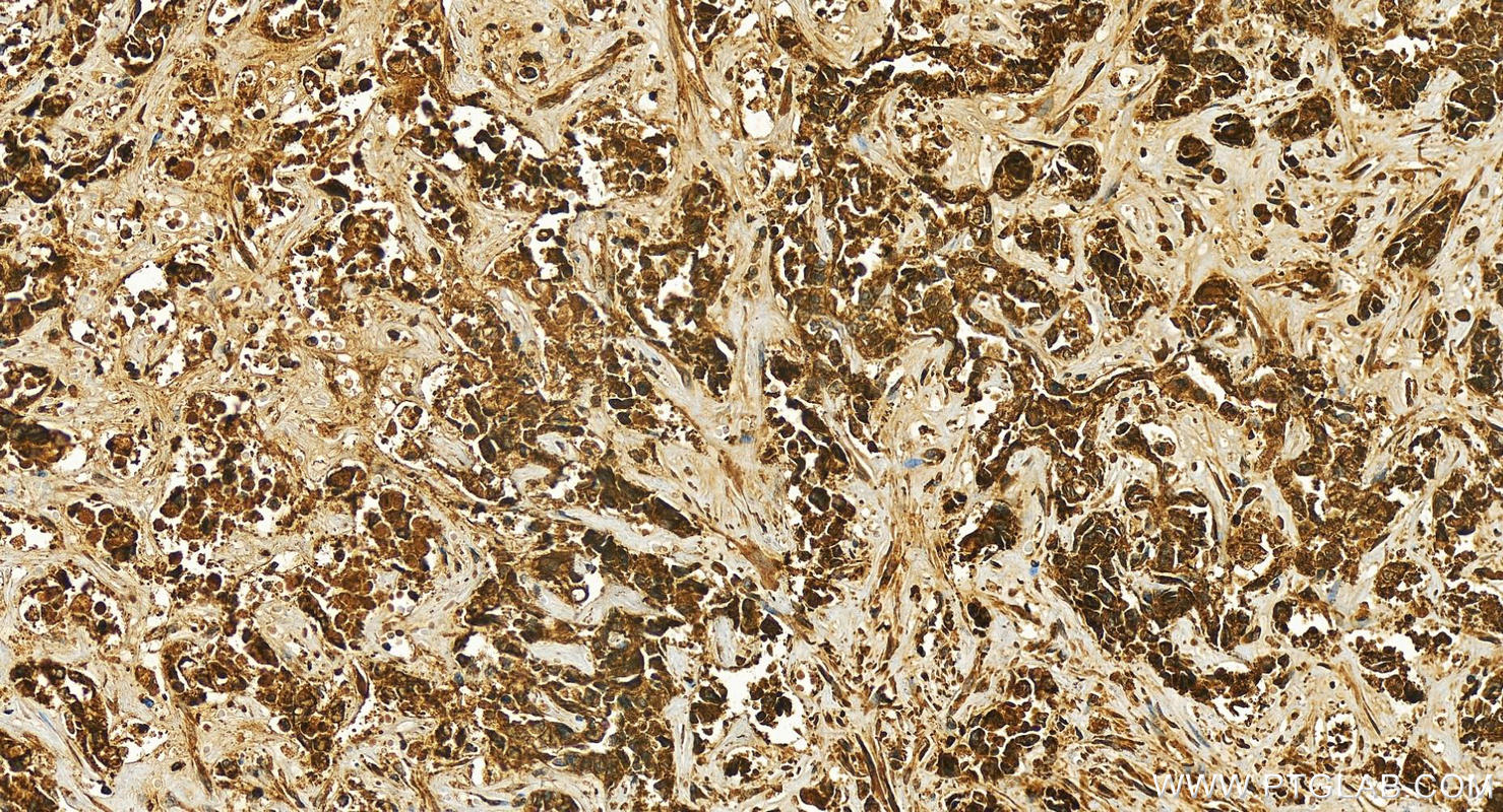 Immunohistochemistry (IHC) staining of human intrahepatic cholangiocarcinoma tissue using Alpha 1 microglobulin Polyclonal antibody (26716-1-AP)