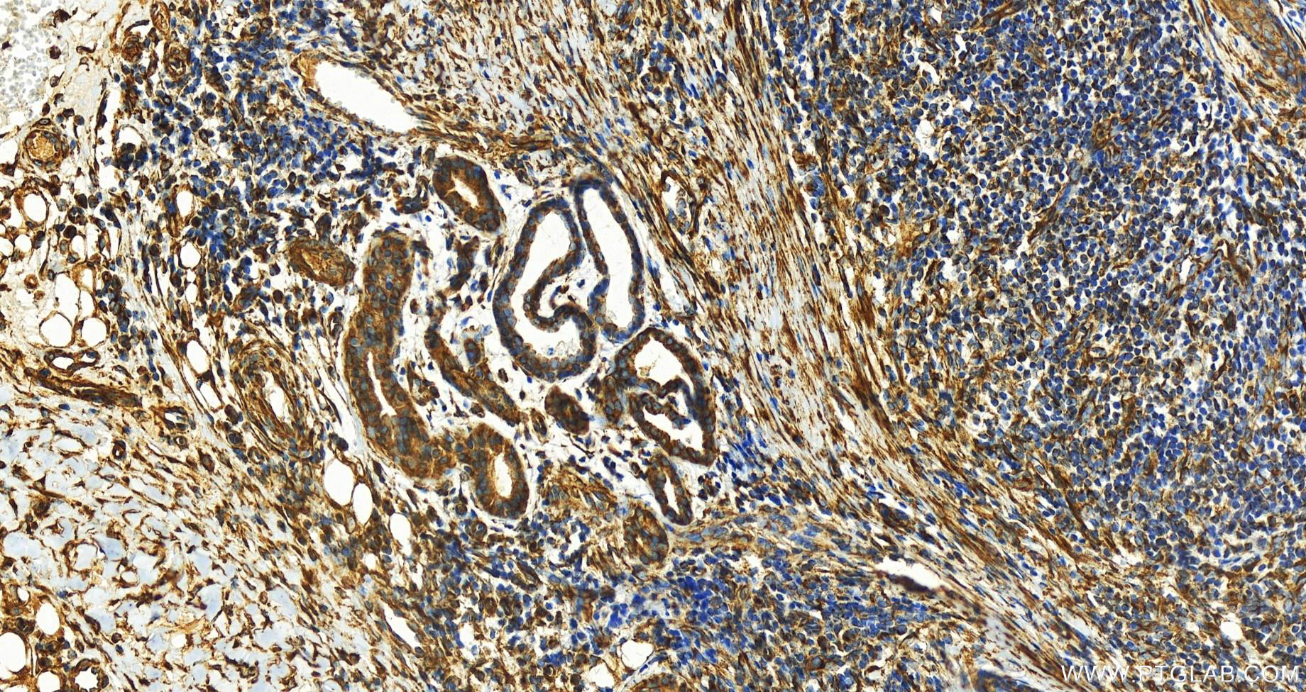 Immunohistochemistry (IHC) staining of human skin cancer tissue using Alpha Tubulin Recombinant antibody (80762-1-RR)