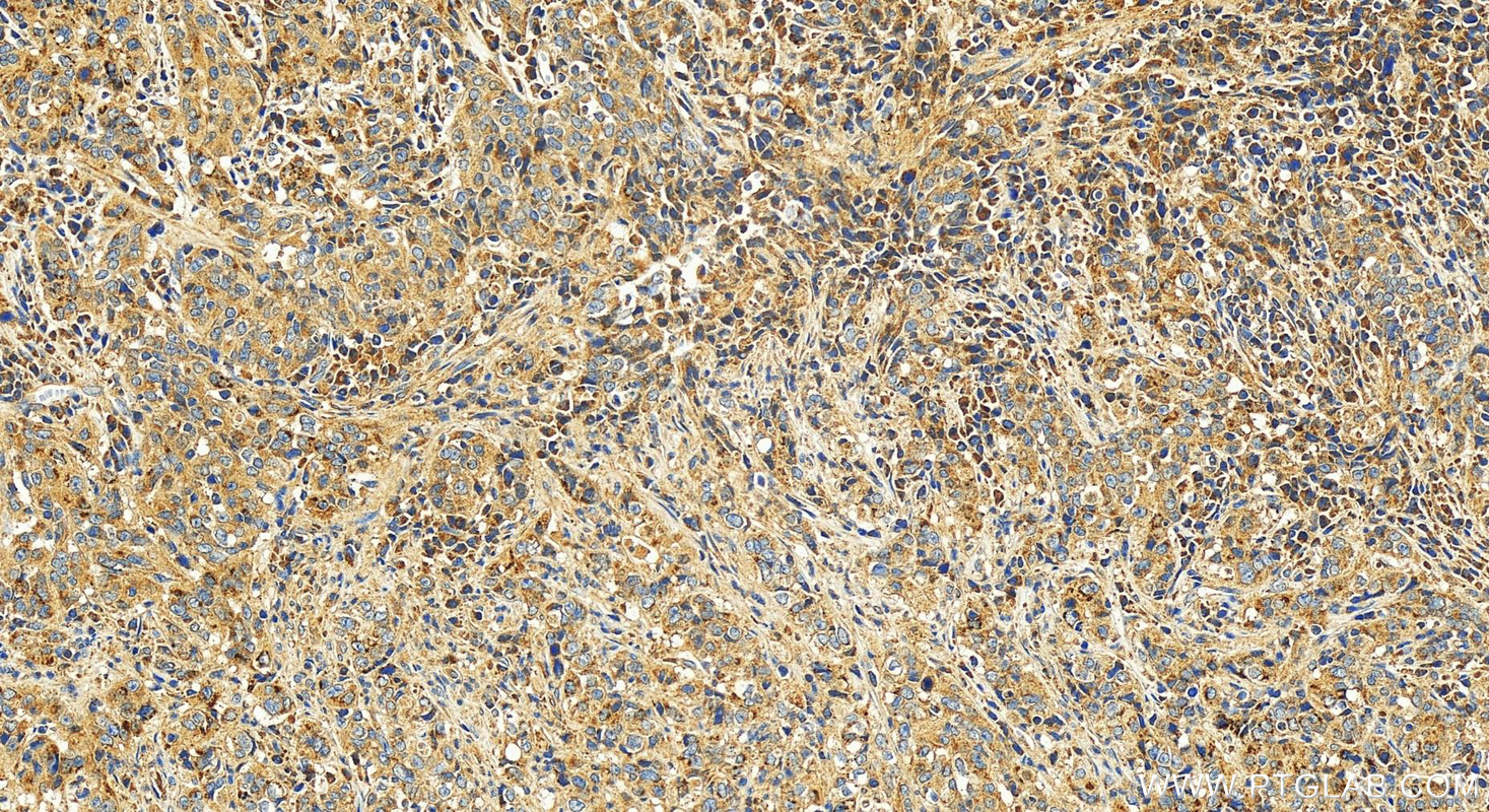 Immunohistochemistry (IHC) staining of human stomach cancer tissue using B3GNT6 Polyclonal antibody (21291-1-AP)