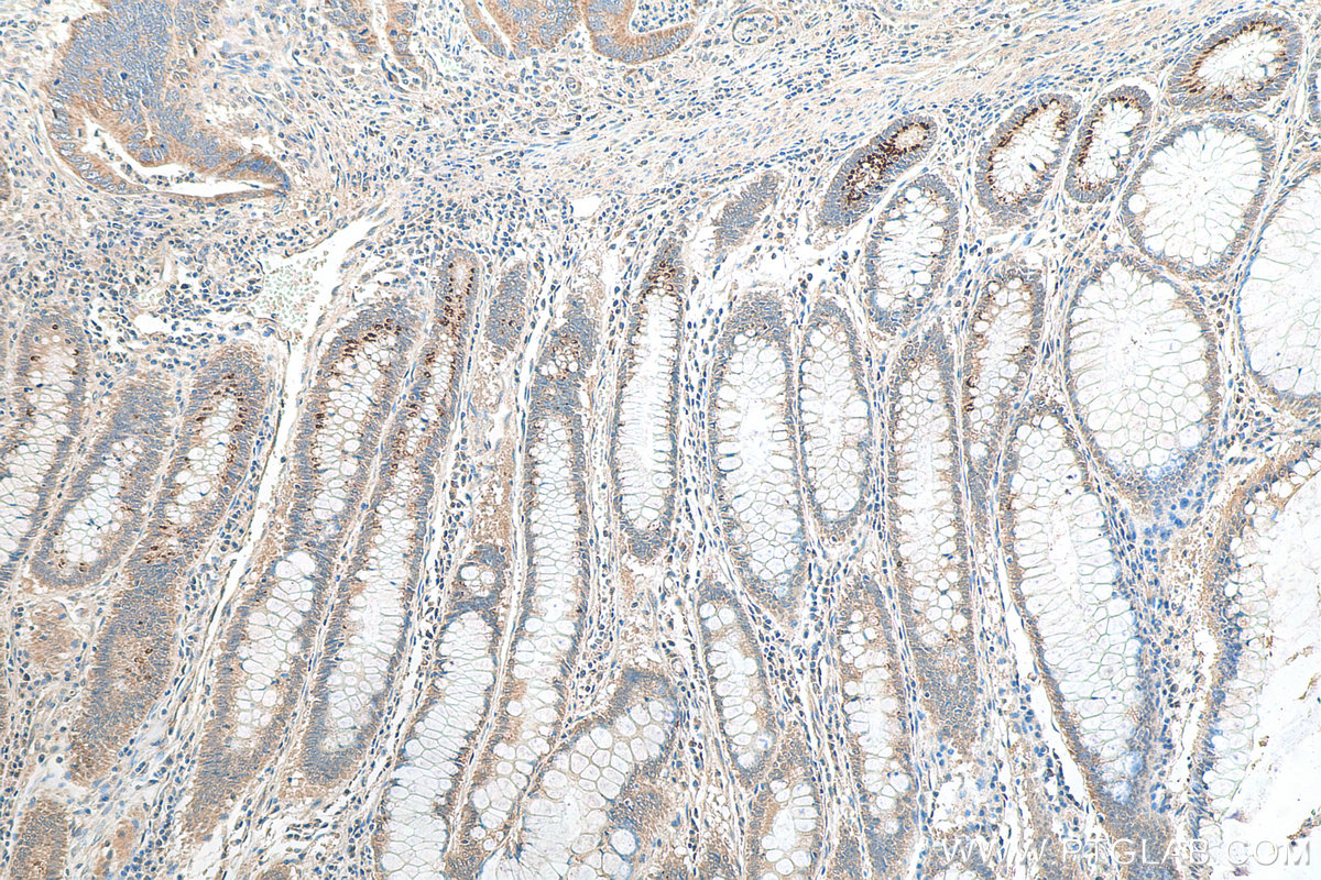 Immunohistochemistry (IHC) staining of human colon cancer tissue using B3GNT6 Polyclonal antibody (21291-1-AP)