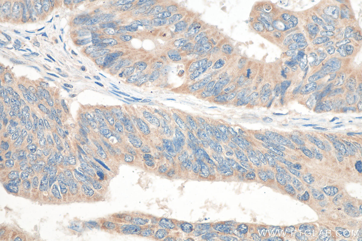 Immunohistochemistry (IHC) staining of human colon cancer tissue using B3GNT6 Polyclonal antibody (21291-1-AP)