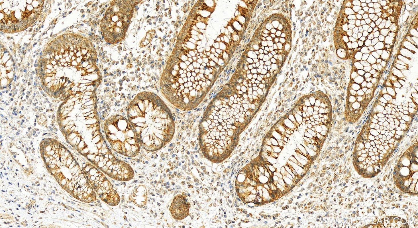 Immunohistochemistry (IHC) staining of human colon cancer tissue using B3GNT7 Polyclonal antibody (22879-1-AP)