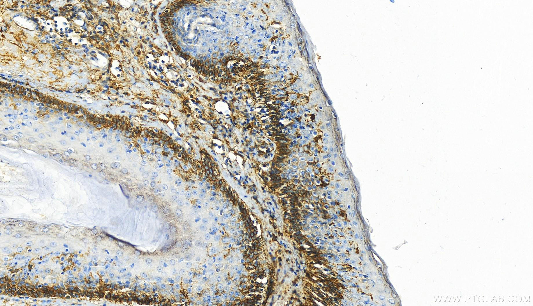 Immunohistochemistry (IHC) staining of human skin cancer tissue using B7-H3/CD276 Polyclonal antibody (30052-1-AP)