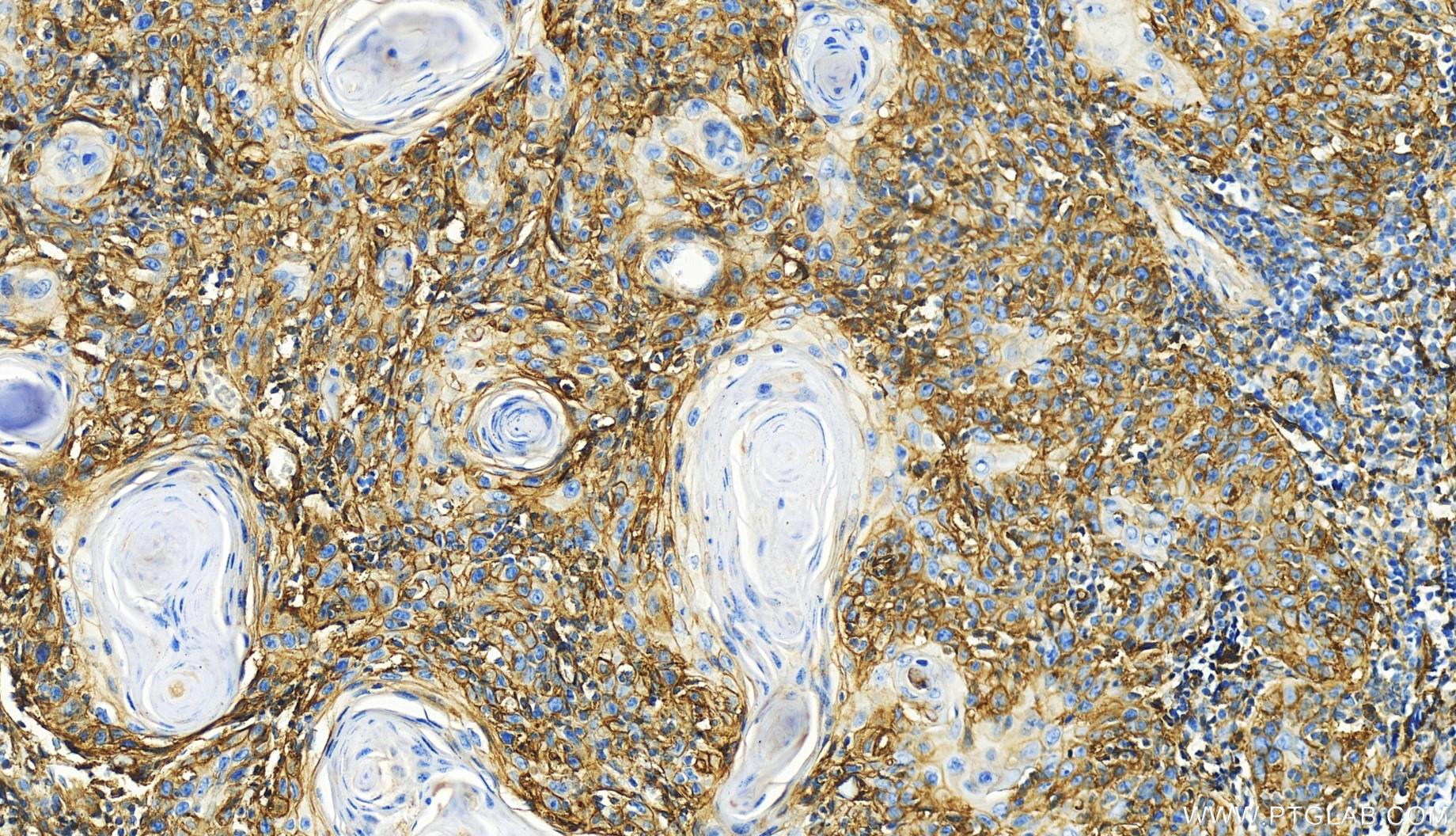 Immunohistochemistry (IHC) staining of human skin cancer tissue using B7-H3/CD276 Polyclonal antibody (30052-1-AP)