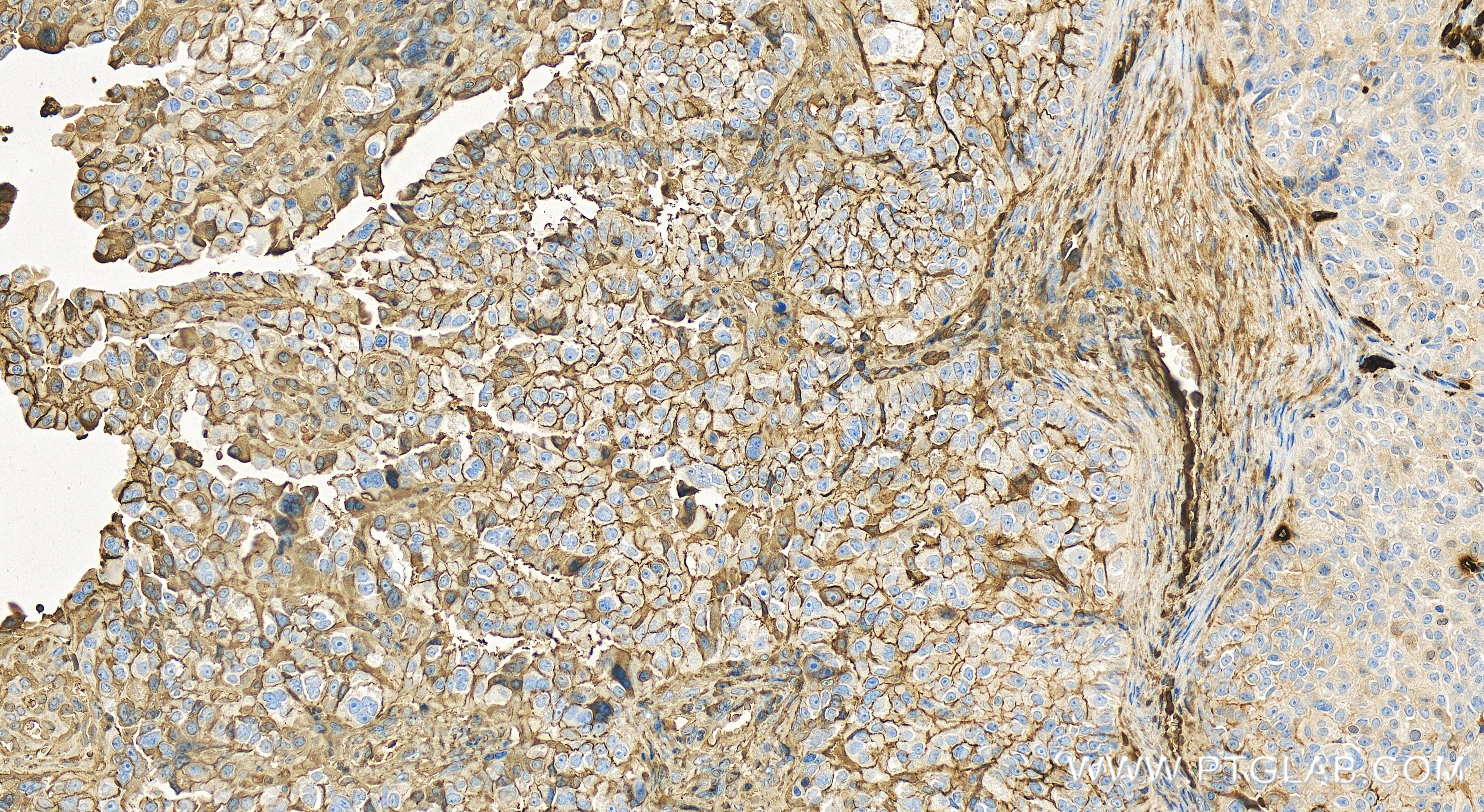 Immunohistochemistry (IHC) staining of human ovary cancer tissue using B7-H4 Recombinant antibody (82850-1-RR)