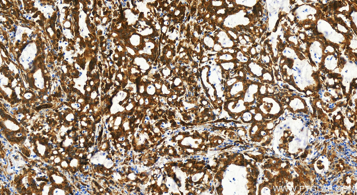 Immunohistochemistry (IHC) staining of human stomach cancer tissue using BAG3 Recombinant antibody (83779-4-RR)