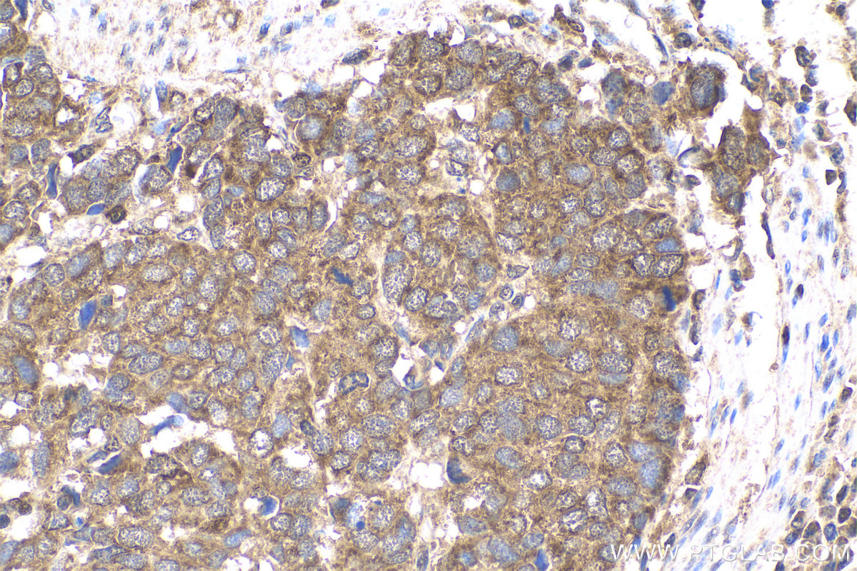 Immunohistochemistry (IHC) staining of human stomach cancer tissue using BAX Monoclonal antibody (60267-1-Ig)