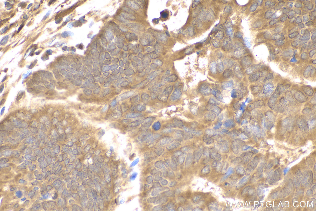 Immunohistochemistry (IHC) staining of human colon cancer tissue using BAX Monoclonal antibody (60267-1-Ig)