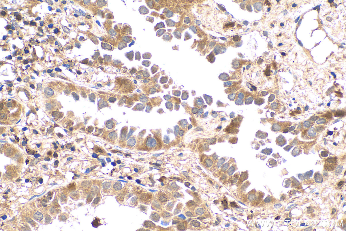 Immunohistochemistry (IHC) staining of human lung cancer tissue using BAX Monoclonal antibody (60267-1-Ig)