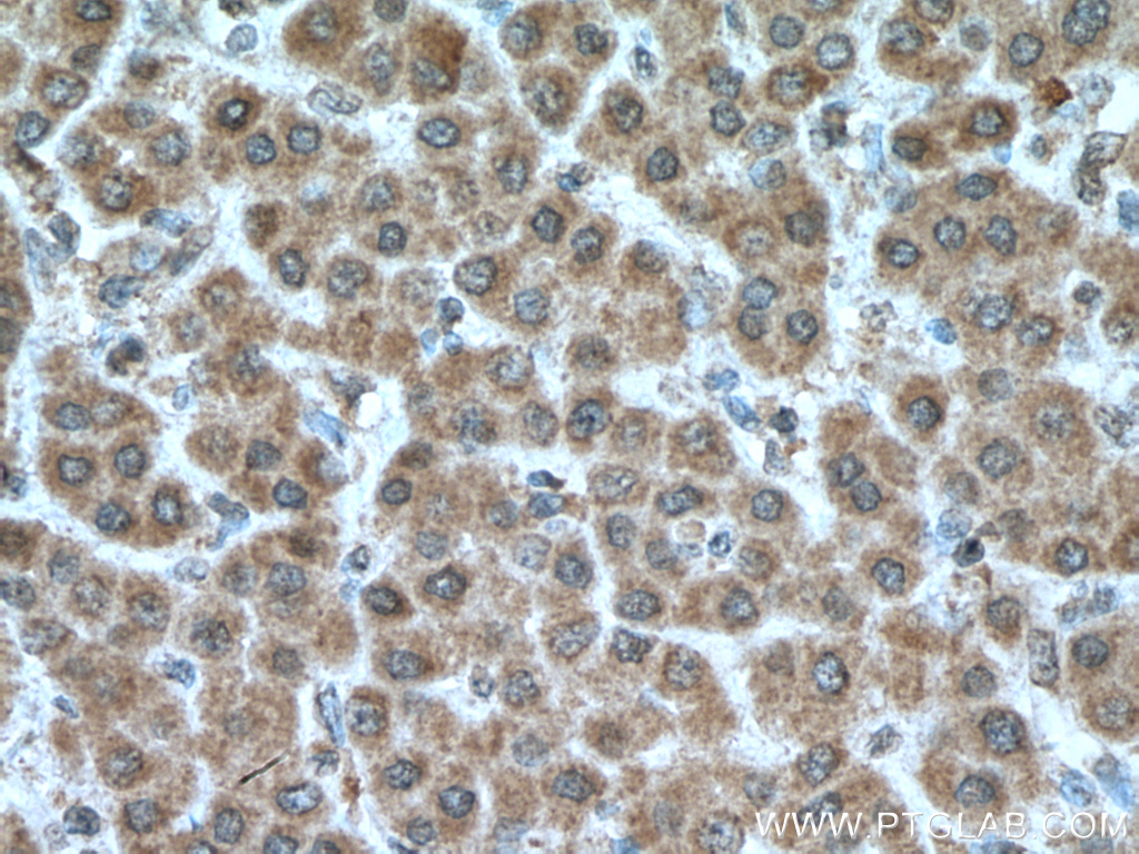 Immunohistochemistry (IHC) staining of human liver cancer tissue using MKS1 Monoclonal antibody (66518-1-Ig)