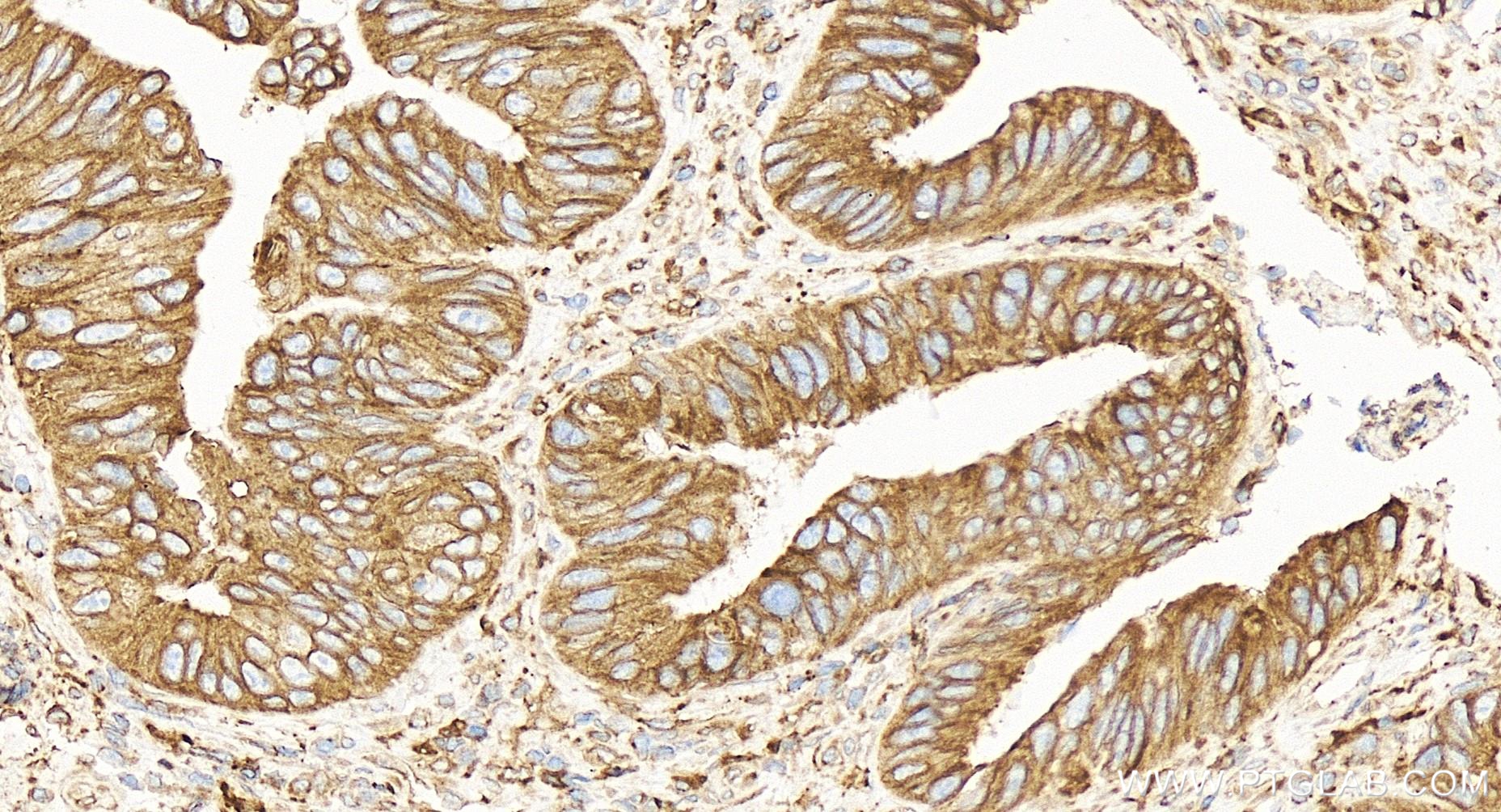 Immunohistochemistry (IHC) staining of human colon cancer tissue using BAP31 Recombinant antibody (84584-5-RR)