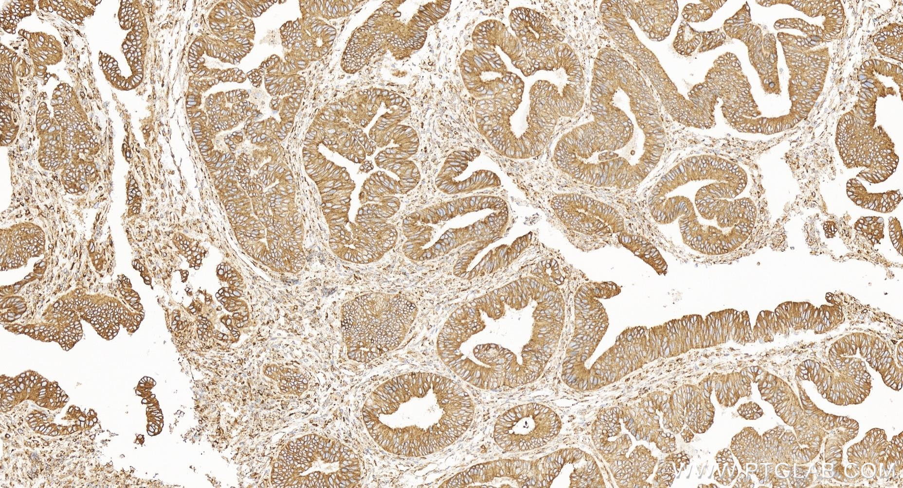 Immunohistochemistry (IHC) staining of human colon cancer tissue using BAP31 Recombinant antibody (84584-5-RR)