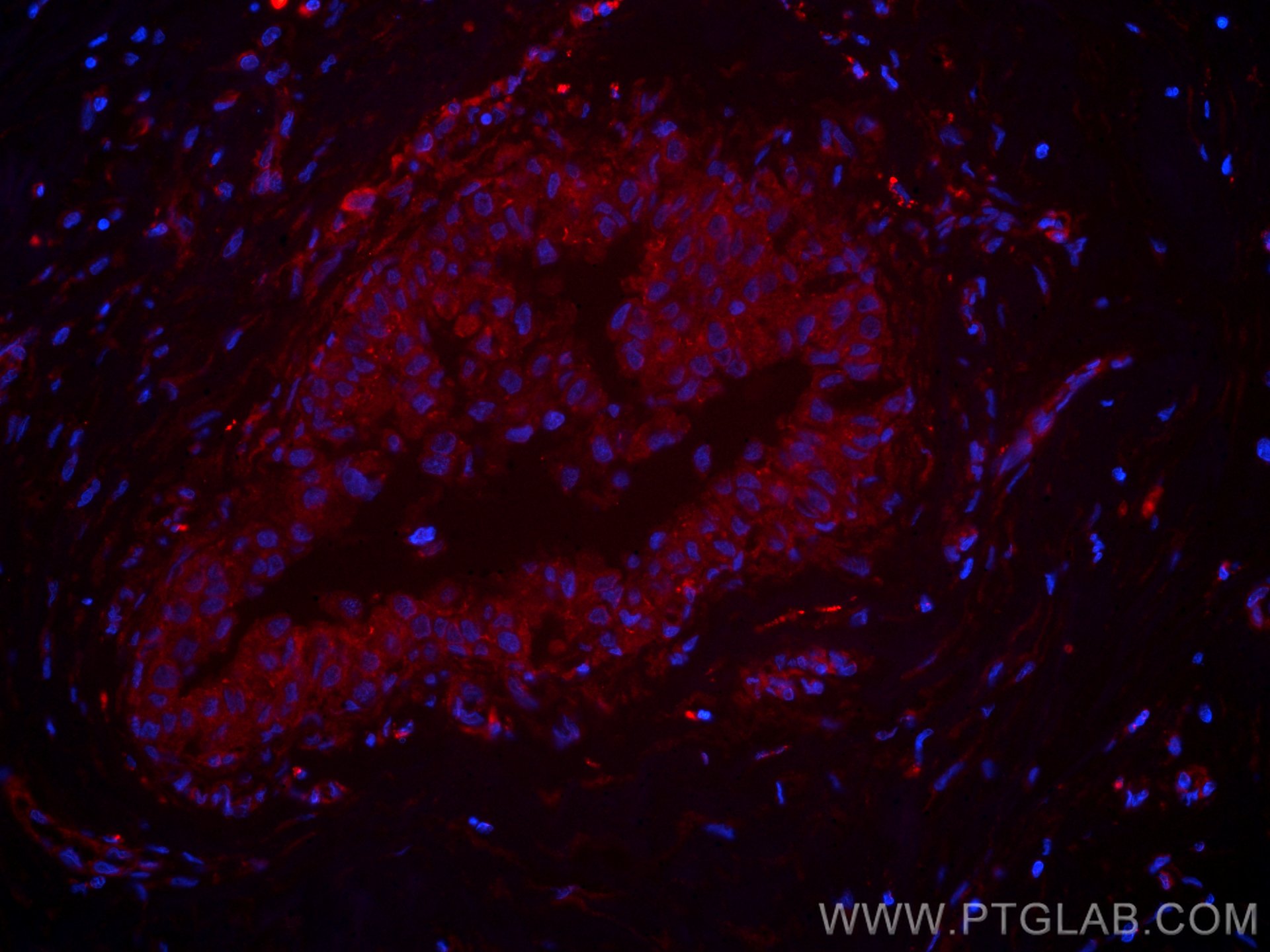 Immunofluorescence (IF) / fluorescent staining of human breast cancer tissue using CoraLite®594-conjugated p130Cas / BCAR1 Monoclonal (CL594-67215)