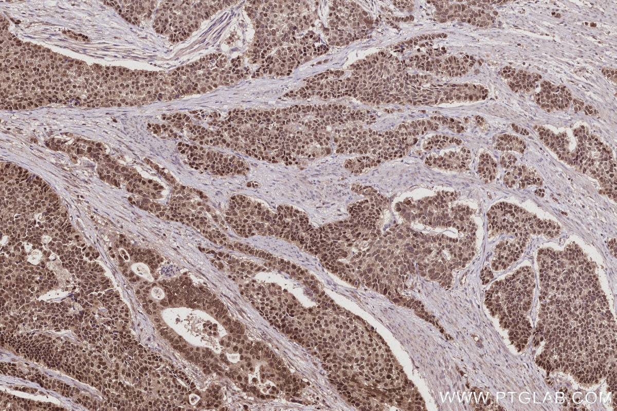 Immunohistochemistry (IHC) staining of human stomach cancer tissue using BCCIP Polyclonal antibody (16043-1-AP)