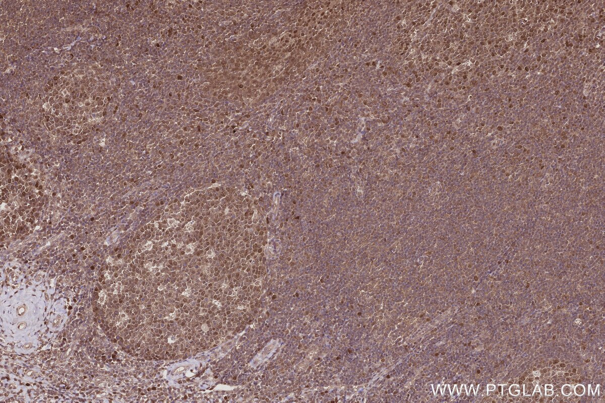 Immunohistochemistry (IHC) staining of human tonsillitis tissue using BCCIP Polyclonal antibody (16043-1-AP)