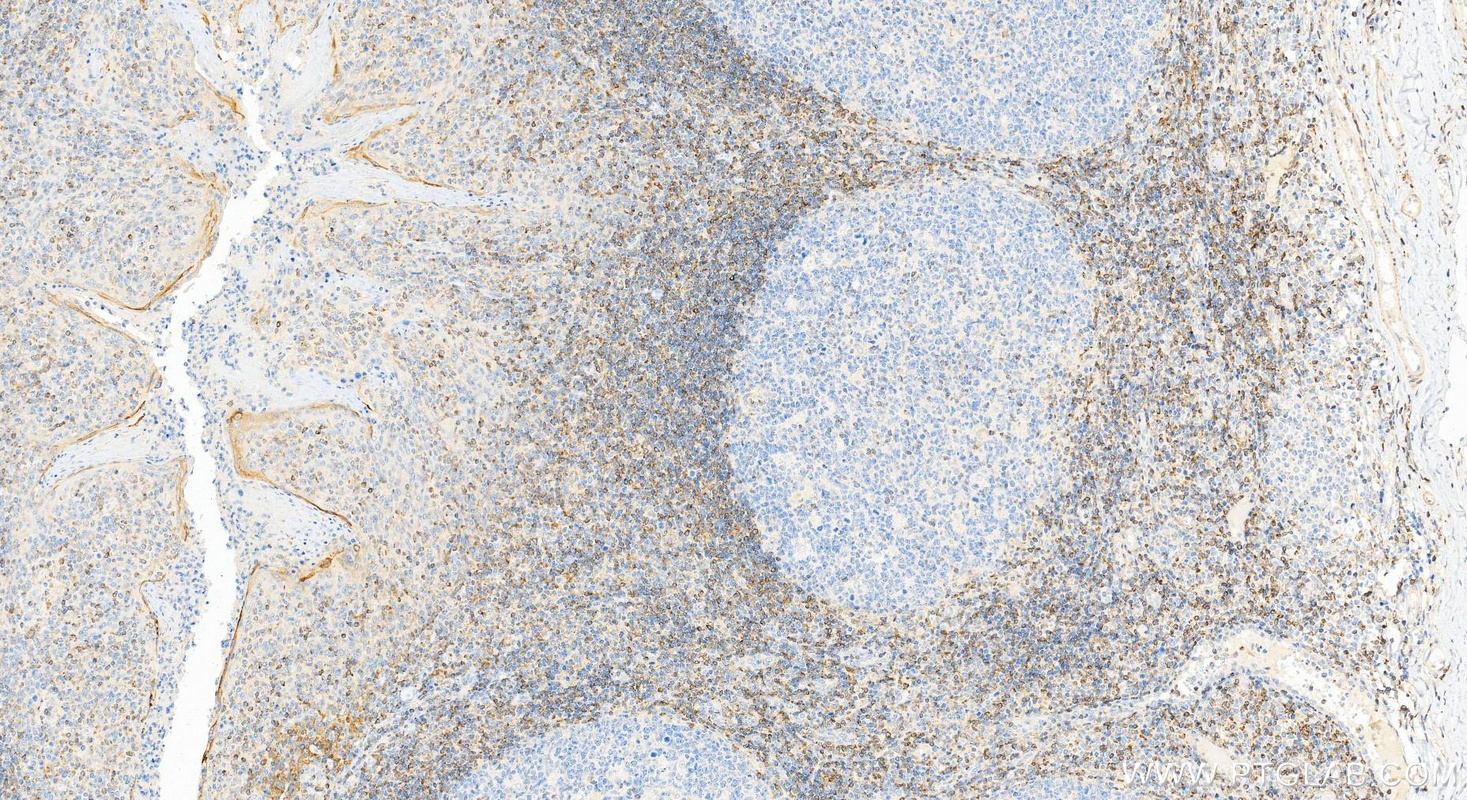 Immunohistochemistry (IHC) staining of human tonsillitis tissue using human BCL2 Polyclonal antibody (12789-1-AP)