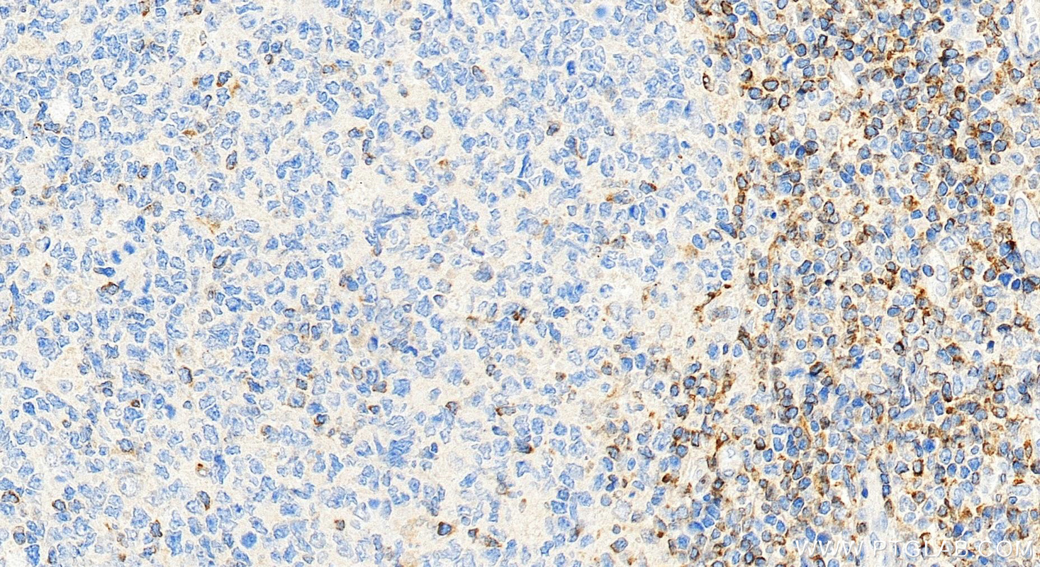 Immunohistochemistry (IHC) staining of human tonsillitis tissue using human BCL2 Polyclonal antibody (12789-1-AP)