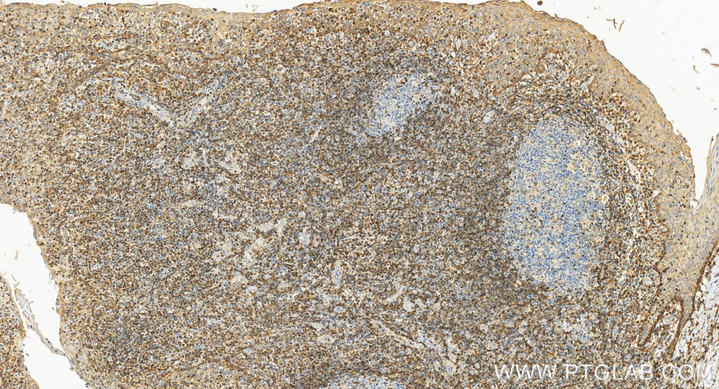 Immunohistochemistry (IHC) staining of human tonsillitis tissue using human BCL2 Polyclonal antibody (12789-1-AP)