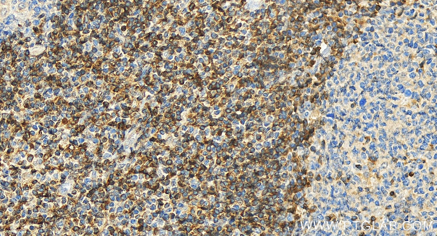 Immunohistochemistry (IHC) staining of human tonsillitis tissue using human BCL2 Polyclonal antibody (12789-1-AP)