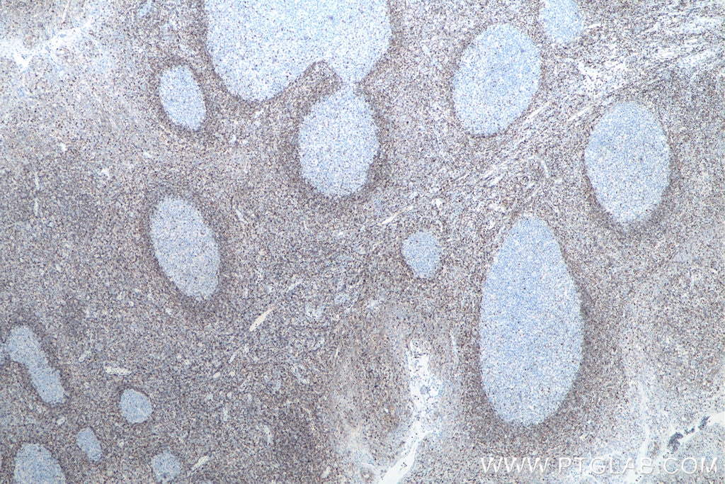 Immunohistochemistry (IHC) staining of human tonsillitis tissue using BCL2 Monoclonal antibody (60178-1-Ig)