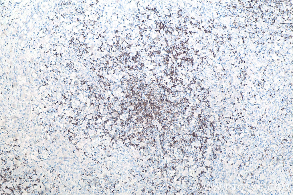 Immunohistochemistry (IHC) staining of human lymphoma tissue using BCL2 Monoclonal antibody (60178-1-Ig)