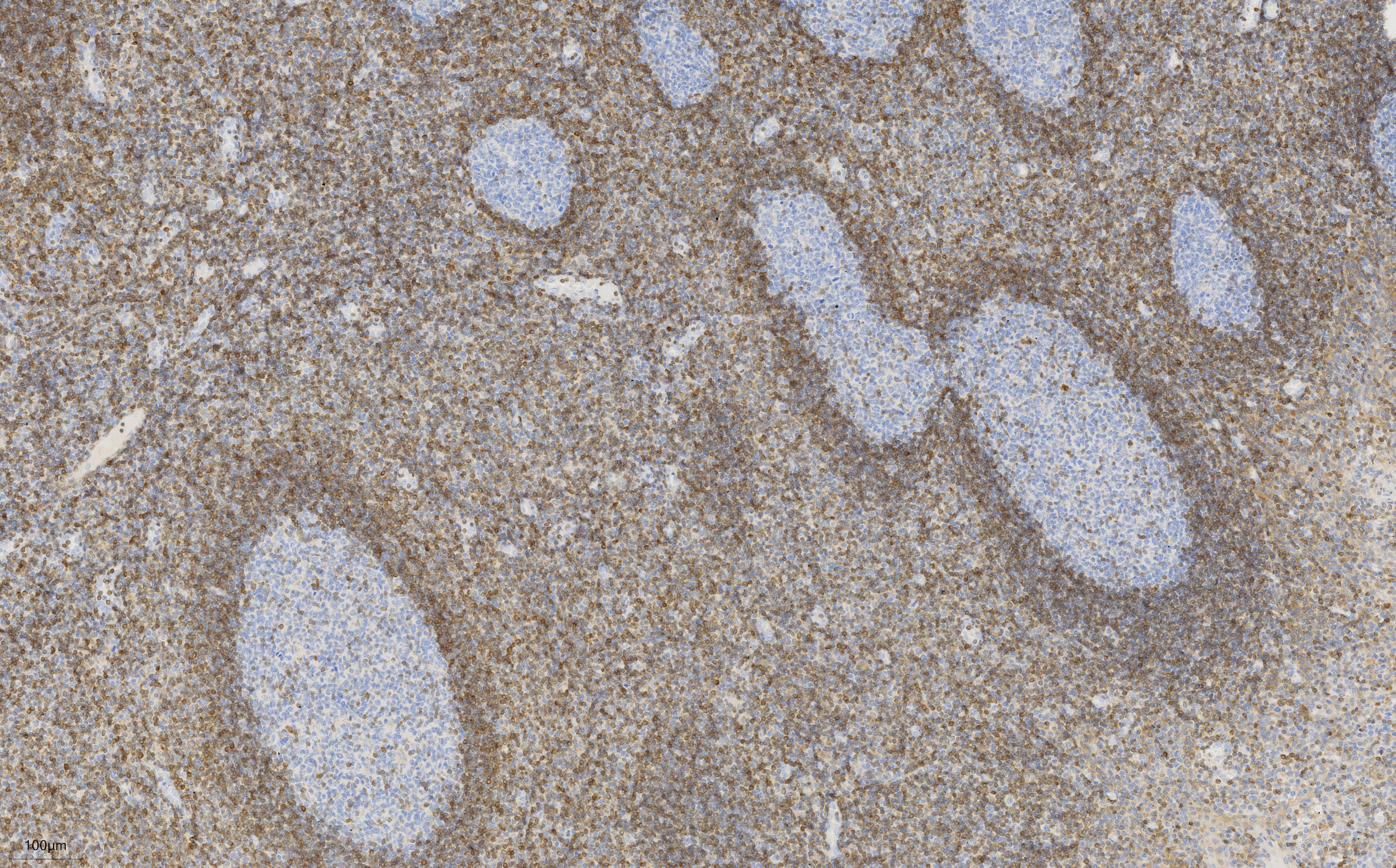 Immunohistochemistry (IHC) staining of human tonsillitis tissue using BCL2 Monoclonal antibody (60178-1-Ig)