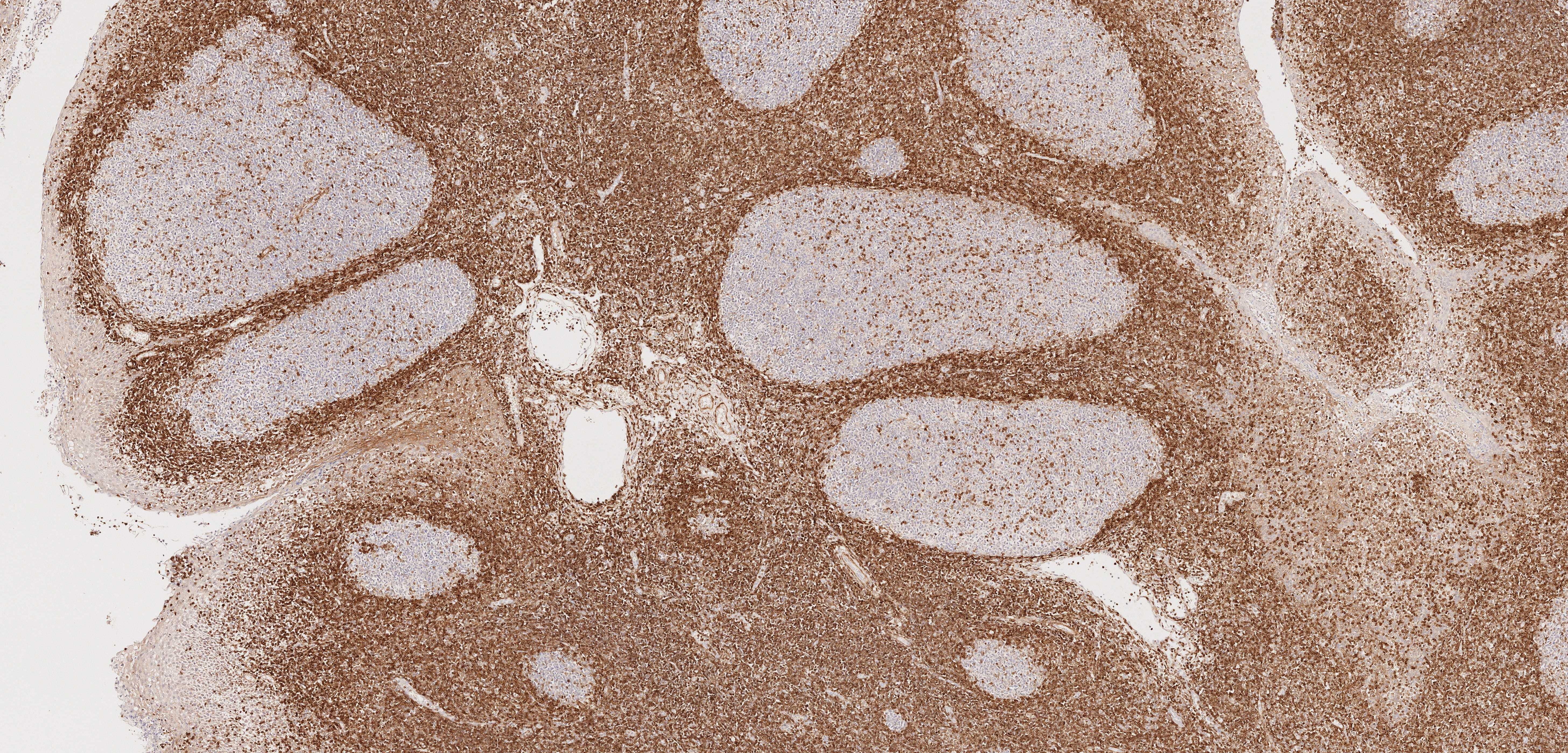 Immunohistochemistry (IHC) staining of human tonsillitis tissue using BCL2 Monoclonal antibody (60178-1-Ig)