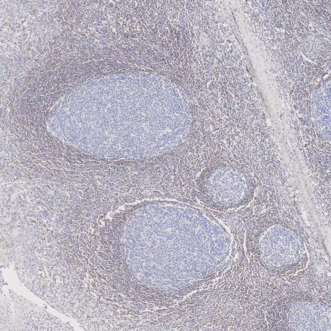 Immunohistochemistry (IHC) staining of human tonsillitis tissue using BCL2 Monoclonal antibody (60178-1-Ig)